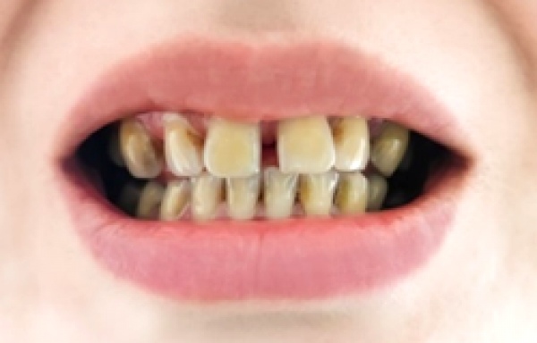 セラミック治療で理想的な美しい歯にサムネイル