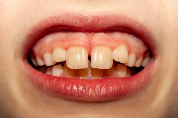 すきっ歯を矯正したい！それ、セラミック治療で解決できるかもサムネイル
