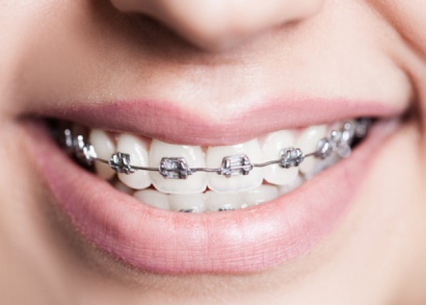歯科矯正とセラミック矯正の違いとそれぞれの良い点と注意点サムネイル
